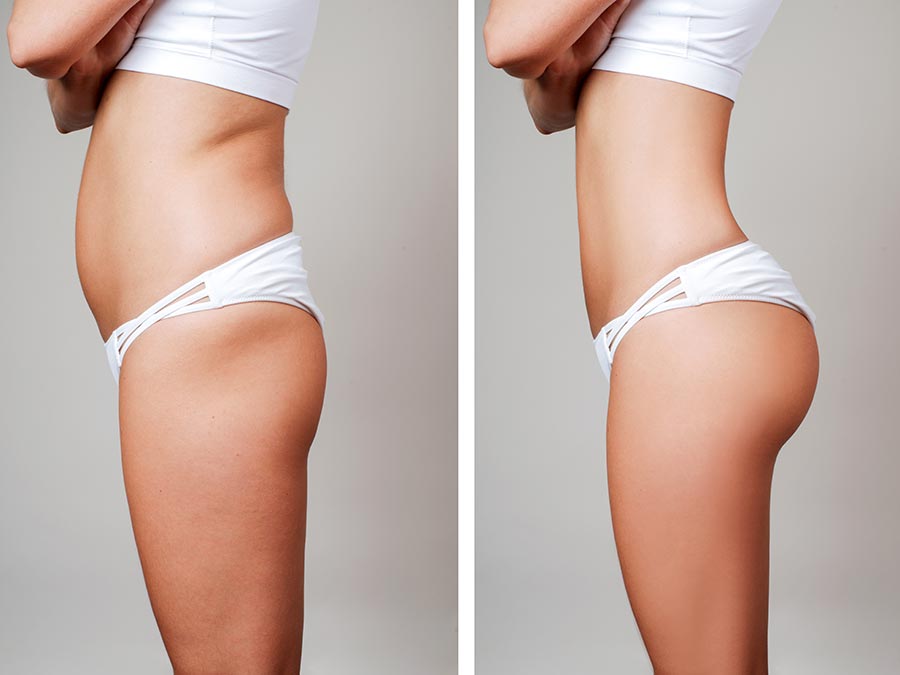 Liposuction before and after