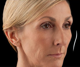 Westlake village juvederm voluma xc model with blonde hair