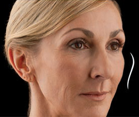 Westlake village juvederm voluma xc model with blonde hair