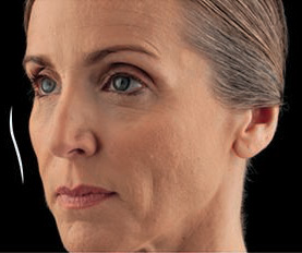 Westlake village juvederm voluma xc model with blonde hair