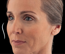Westlake village juvederm voluma xc model with blonde hair