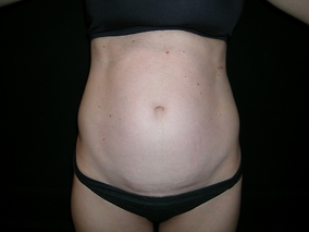 Abdominoplasty Before & After Image