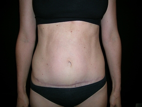 Abdominoplasty Before & After Image