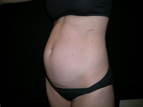 Abdominoplasty Before & After Image