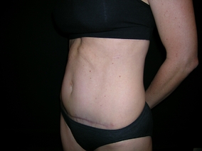 Abdominoplasty Before & After Image