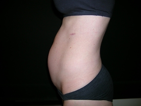 Abdominoplasty Before & After Image