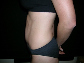 Abdominoplasty Before & After Image