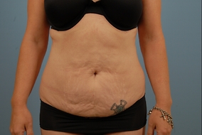 Abdominoplasty Before & After Image