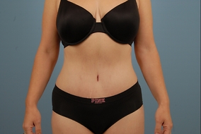 Abdominoplasty Before & After Image