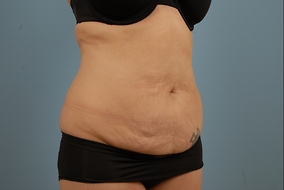 Abdominoplasty Before & After Image