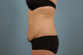 Abdominoplasty Before & After Image