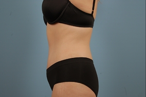 Abdominoplasty Before & After Image