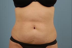 Abdominoplasty Before & After Image