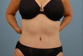 Abdominoplasty Before & After Image