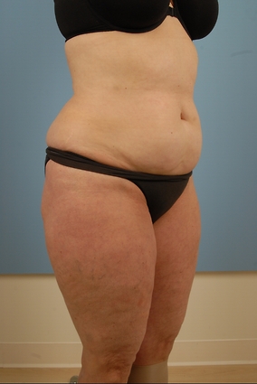 Abdominoplasty Before & After Image