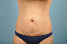 Abdominoplasty Before & After Image