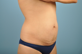 Abdominoplasty Before & After Image