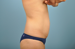 Abdominoplasty Before & After Image