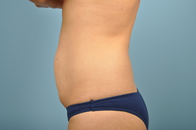 Abdominoplasty Before & After Image