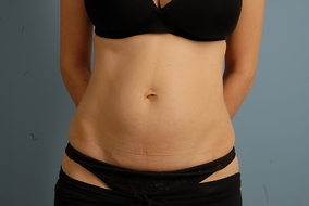 Abdominoplasty Before & After Image