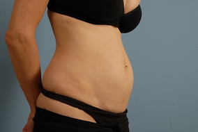 Abdominoplasty Before & After Image