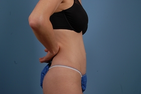 Abdominoplasty Before & After Image