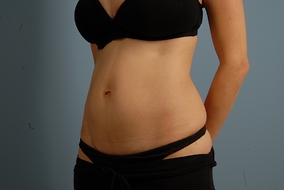 Abdominoplasty Before & After Image