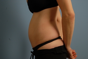 Abdominoplasty Before & After Image