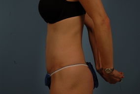 Abdominoplasty Before & After Image