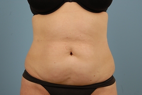 Abdominoplasty Before & After Image