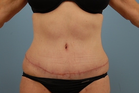 Abdominoplasty Before & After Image