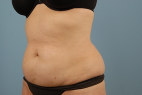 Abdominoplasty Before & After Image