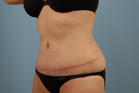 Abdominoplasty Before & After Image