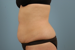 Abdominoplasty Before & After Image