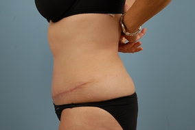 Abdominoplasty Before & After Image