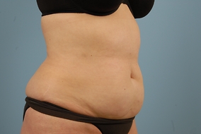 Abdominoplasty Before & After Image