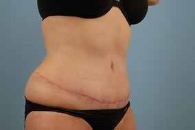 Abdominoplasty Before & After Image