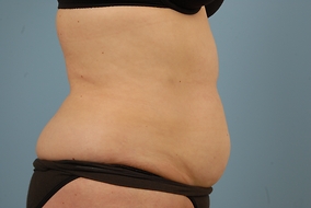 Abdominoplasty Before & After Image