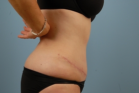 Abdominoplasty Before & After Image