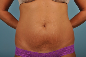 Abdominoplasty Before & After Image