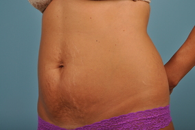 Abdominoplasty Before & After Image