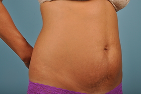 Abdominoplasty Before & After Image