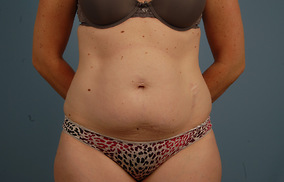 Abdominoplasty Before & After Image