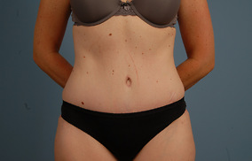 Abdominoplasty Before & After Image