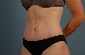 Abdominoplasty Before & After Image