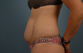 Abdominoplasty Before & After Image