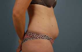 Abdominoplasty Before & After Image