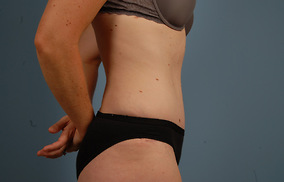 Abdominoplasty Before & After Image