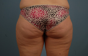 Abdominoplasty Before & After Image