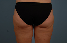 Abdominoplasty Before & After Image